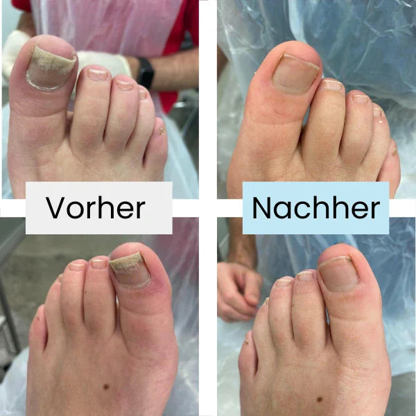"Fortschrittliches Lasertherapiegerät zur effektiven Nagelpilzbehandlung, handlich und einfach zu bedienen."