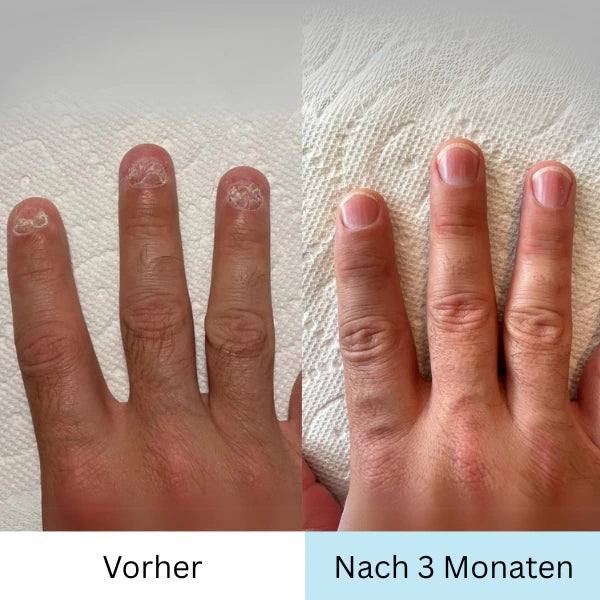 "RevitaNail Nagelpilz Therapie, klare Flüssigkeit, hellblaues Etikett, effektive Nagelpflege, fördert gesundes Wachstum"