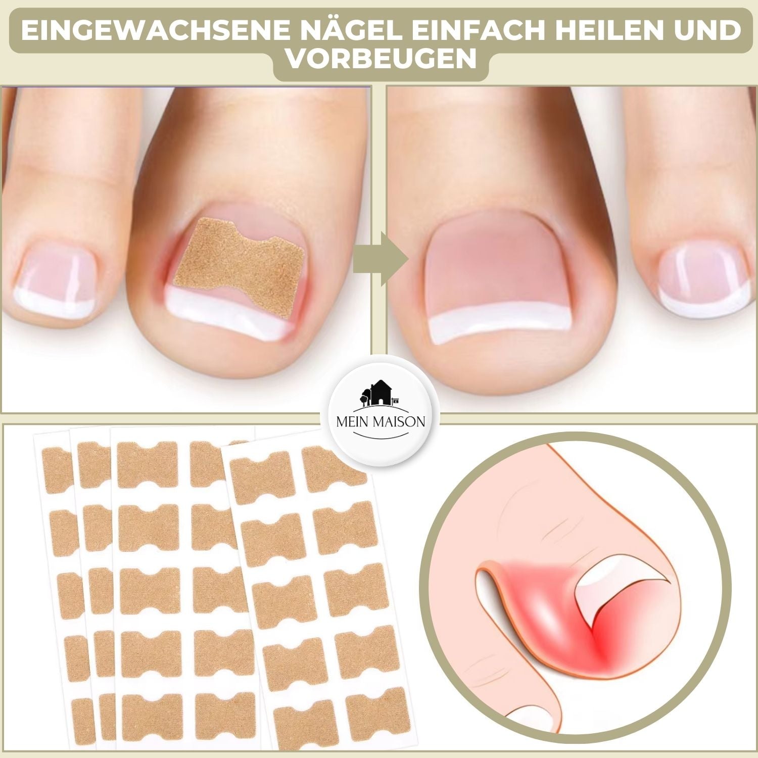 "Sofortige Nagelkorrektur: Transparent, diskret auf Nägel anwendbar, bietet Linderung bei eingewachsenen und deformierten Näg