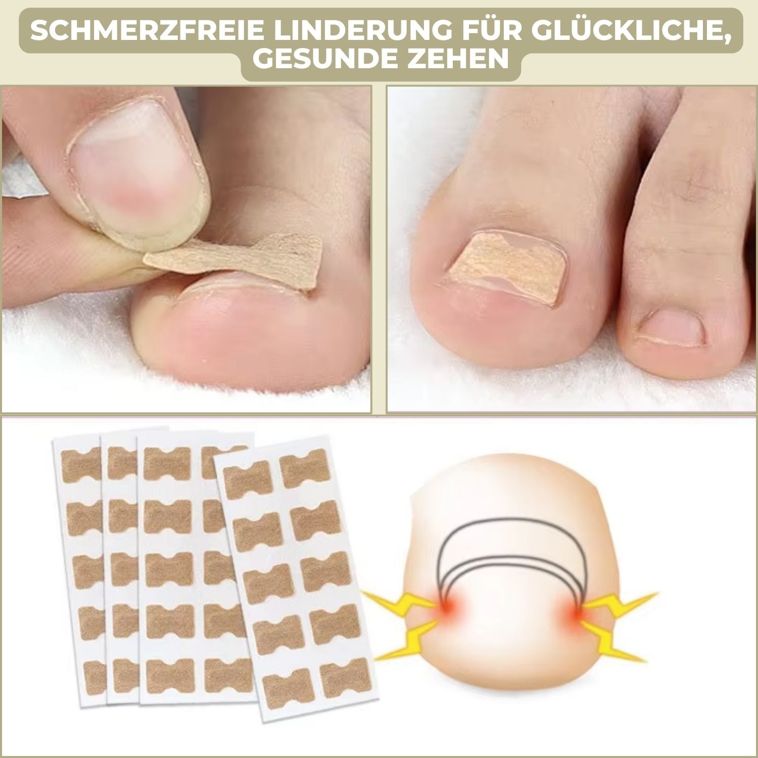 "Sofortige Nagelkorrektur: Transparent, diskret auf Nägel anwendbar, bietet Linderung bei eingewachsenen und deformierten Näg