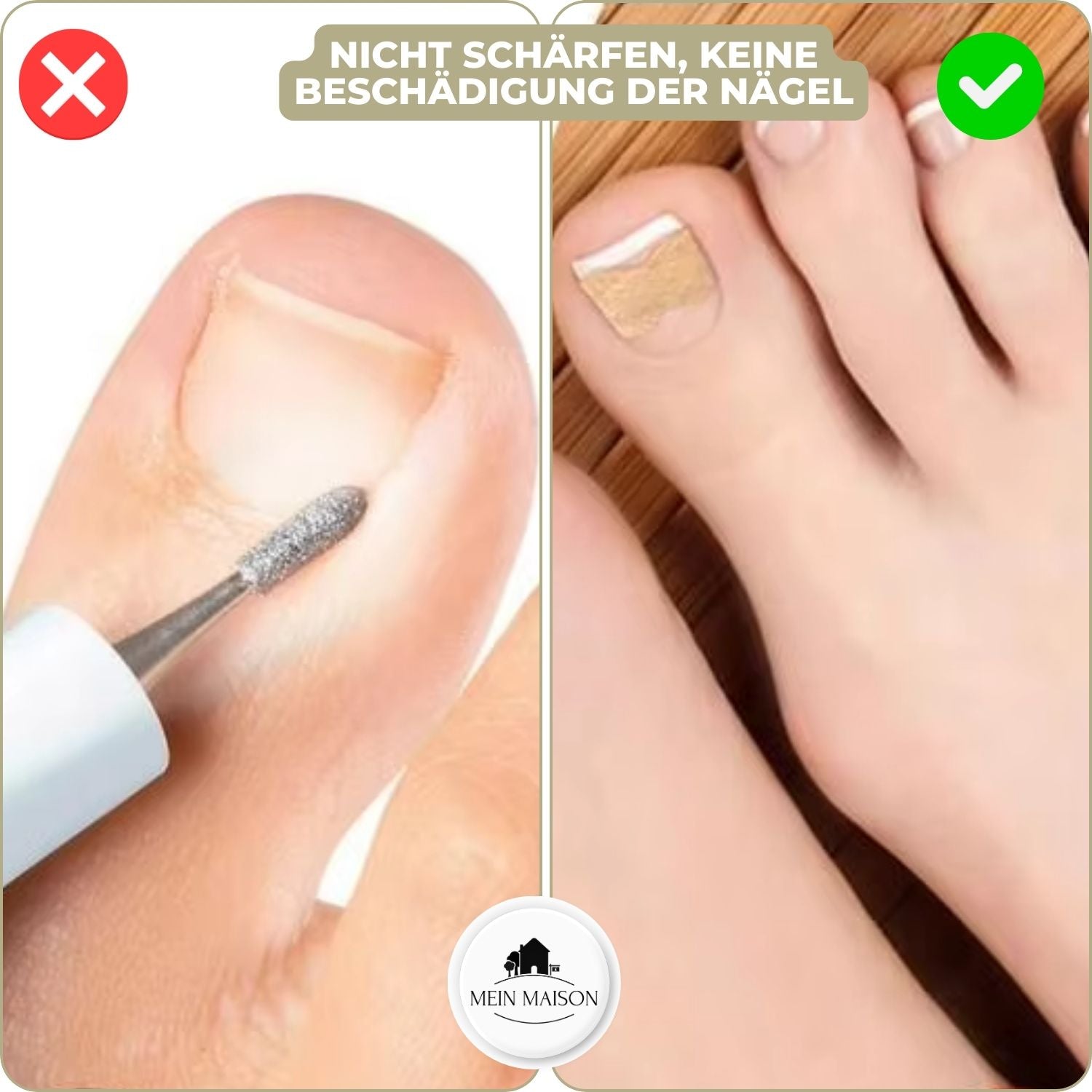 "Sofortige Nagelkorrektur: Transparent, diskret auf Nägel anwendbar, bietet Linderung bei eingewachsenen und deformierten Näg
