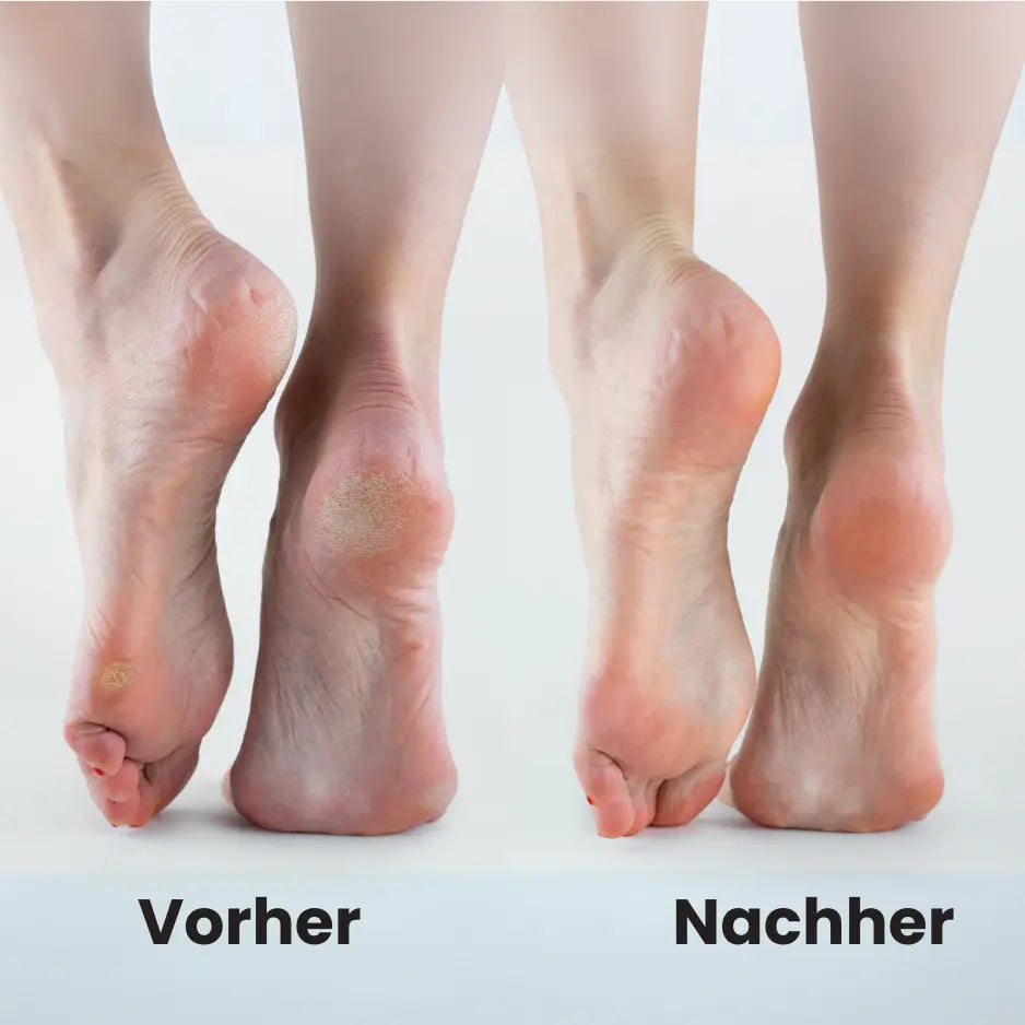 Elektrischer Hornhautentferner mit ergonomischem Design und Mikro-Abrasions-Technologie für weiche, gepflegte Füße.