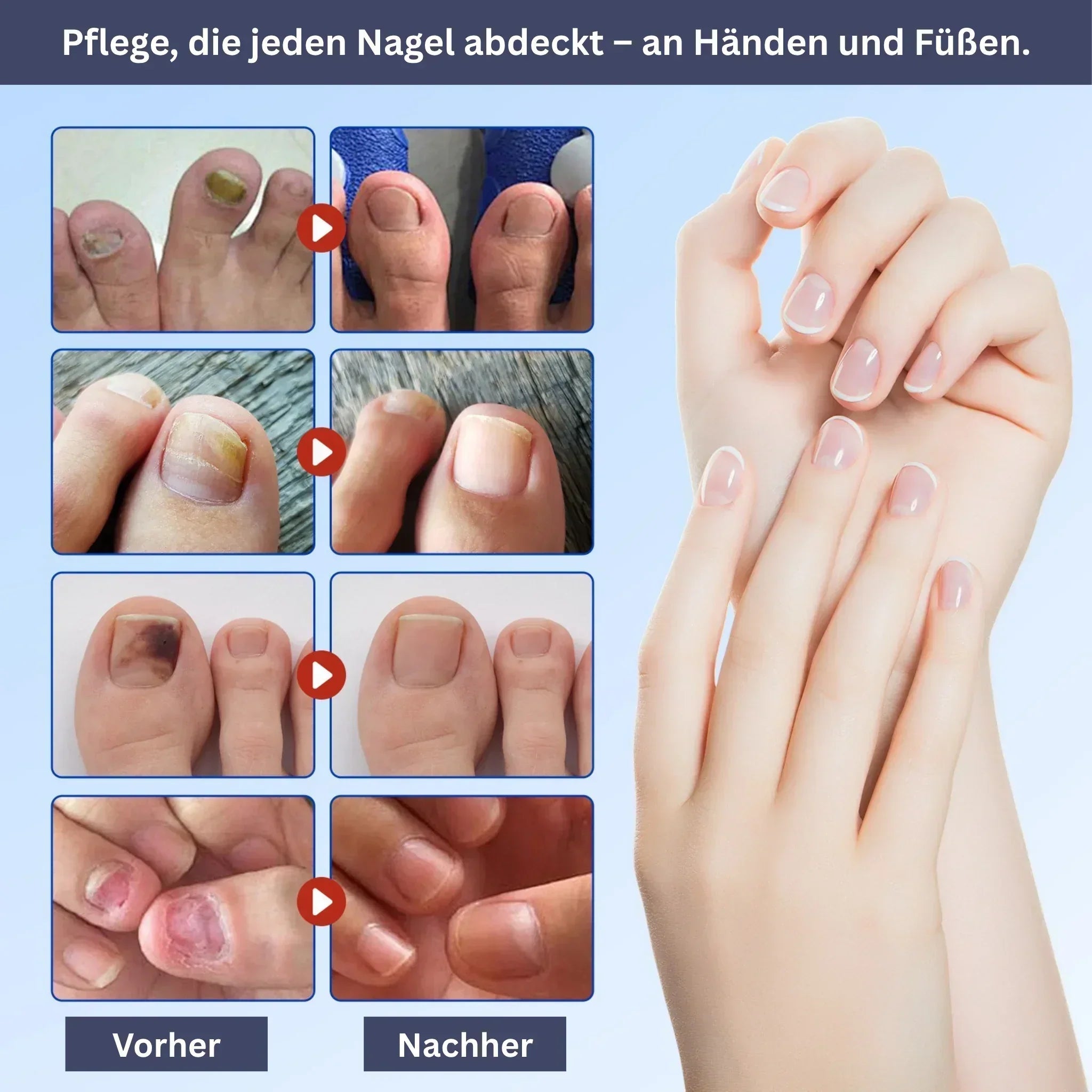 "Feuchtigkeitsspendende Nagelpflege Hydrogel-Patches, transparent, auf Nägeln angewendet für intensive Pflege und Glanz"