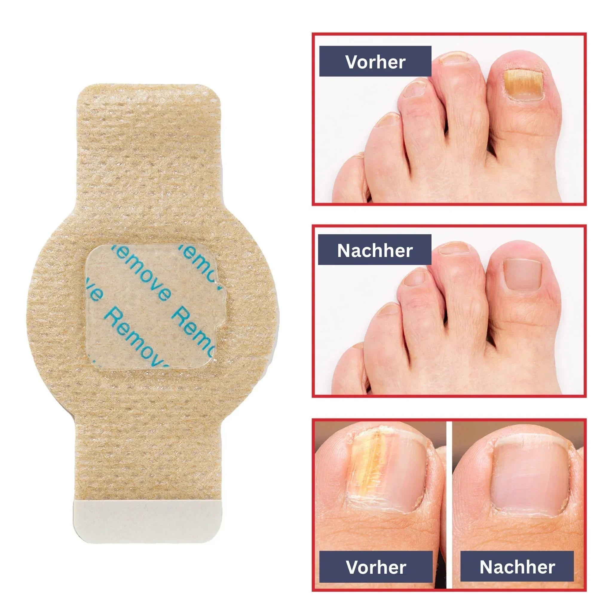 "Feuchtigkeitsspendende Nagelpflege Hydrogel-Patches, transparent, auf Nägeln angewendet für intensive Pflege und Glanz"