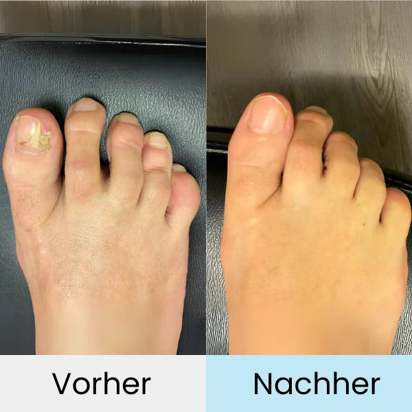 "Fortschrittliches Lasertherapiegerät zur effektiven Nagelpilzbehandlung, handlich und einfach zu bedienen."