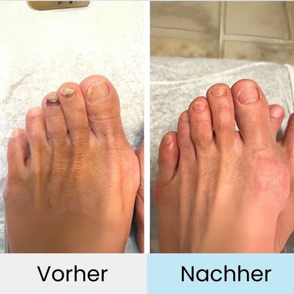 "Fortschrittliches Lasertherapiegerät zur effektiven Nagelpilzbehandlung, handlich und einfach zu bedienen."