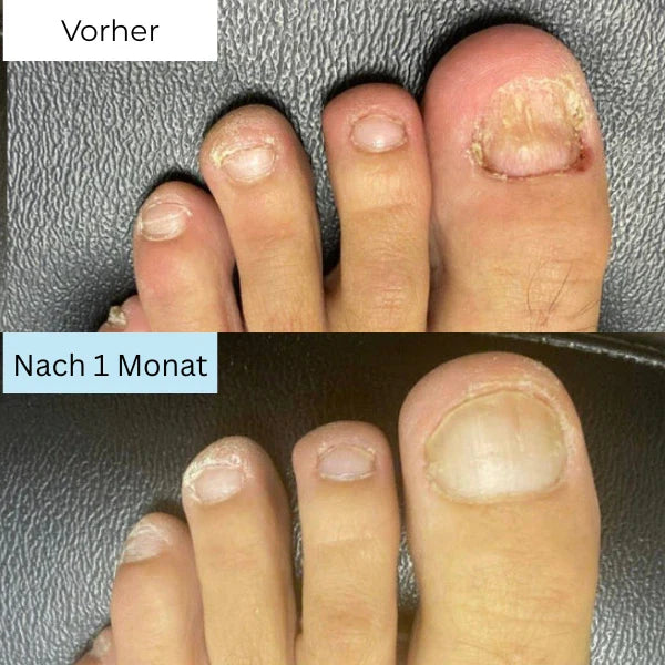 "RevitaNail Nagelpilz Therapie, klare Flüssigkeit, hellblaues Etikett, effektive Nagelpflege, fördert gesundes Wachstum"