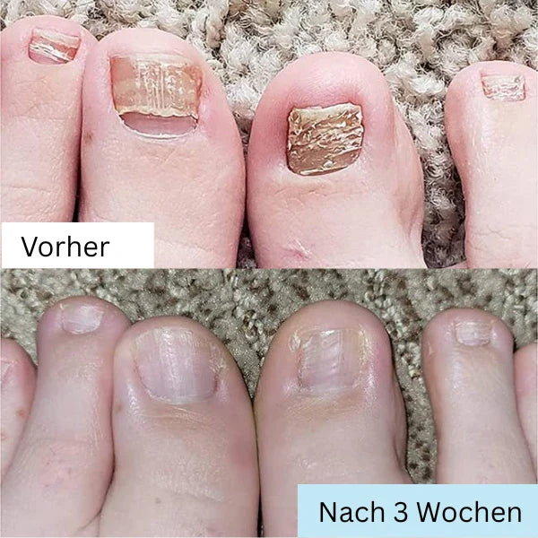 "RevitaNail Nagelpilz Therapie, klare Flüssigkeit, hellblaues Etikett, effektive Nagelpflege, fördert gesundes Wachstum"