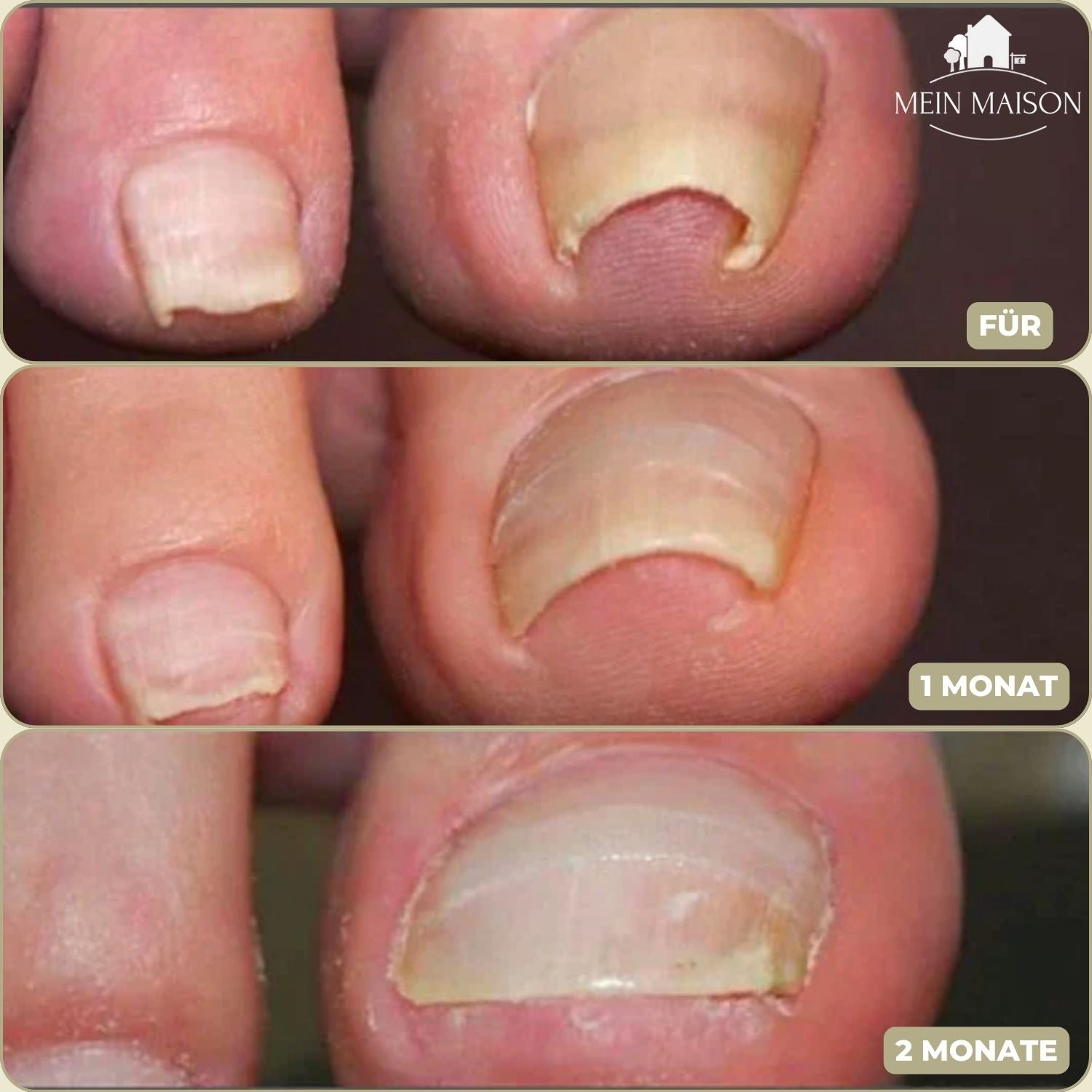 "Sofortige Nagelkorrektur: Transparent, diskret auf Nägel anwendbar, bietet Linderung bei eingewachsenen und deformierten Näg