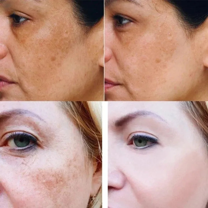 Effektivt gurkemeie serum for hudpleie som fjerner pigmentflekker og mørke flekker for klarere hud.